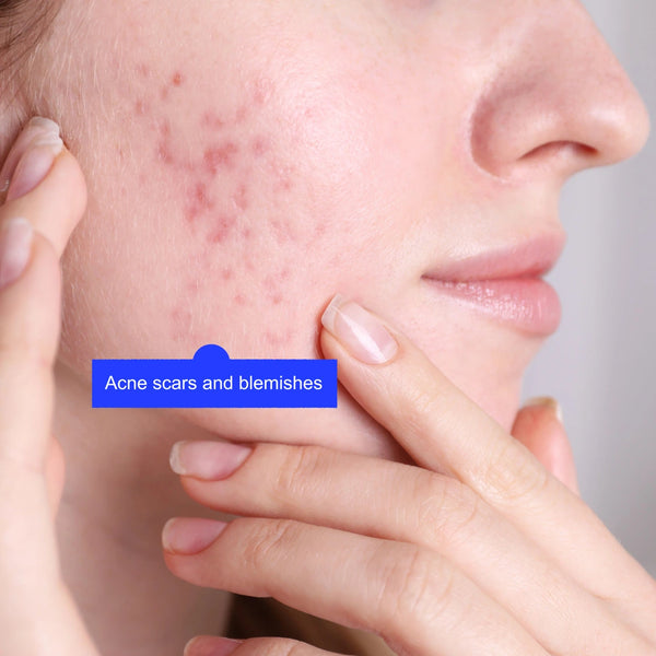 Acne and scarring treatment by Lavié Labs