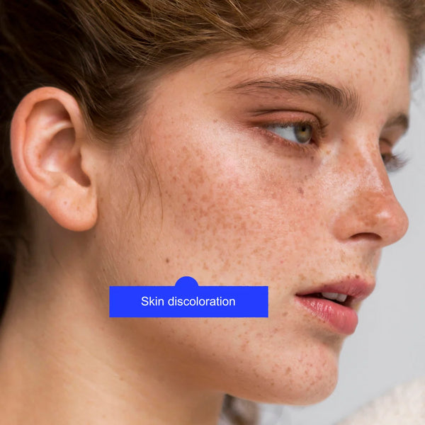 Melasma treatment by Lavié Labs