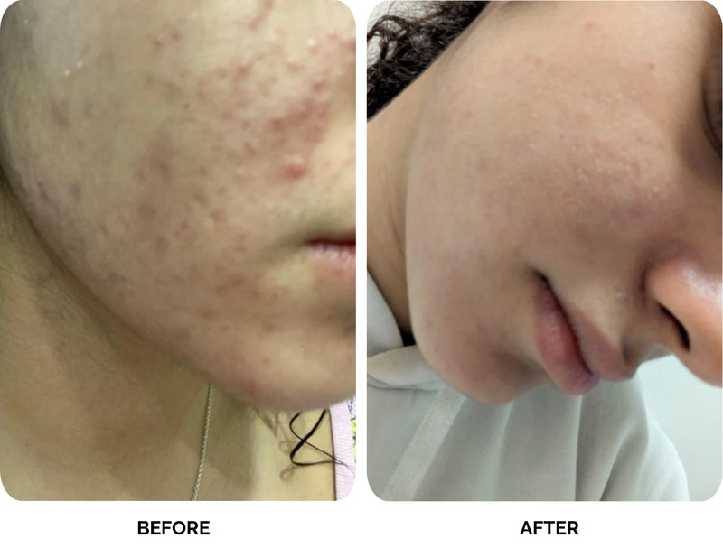 Before and after results of Lavié Labs acne treatment showing reduced breakouts after 7 days