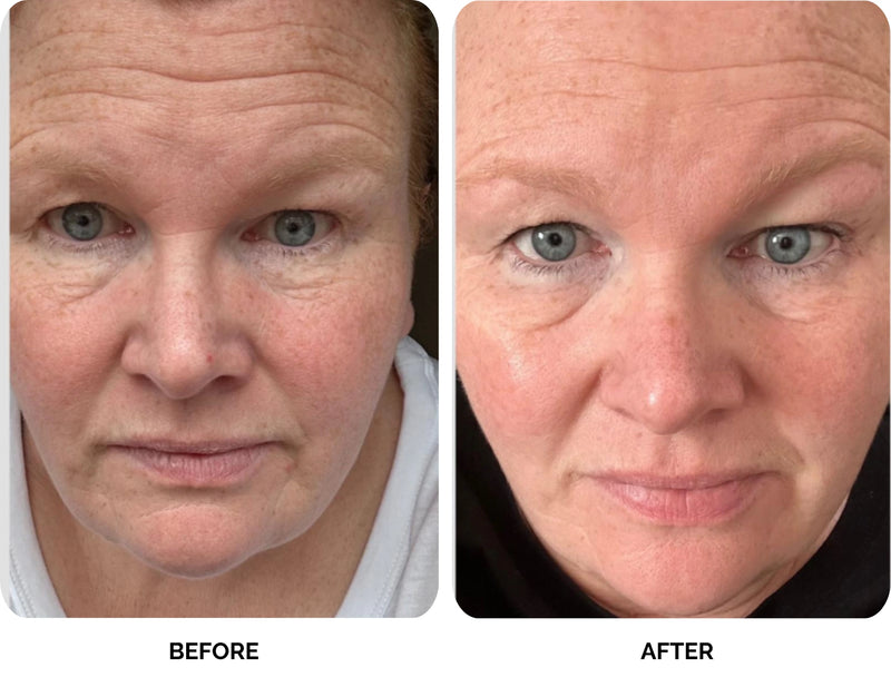 Before and after results of Lavié Labs anti-ageing treatment showing softened fine lines and wrinkles after 45 days