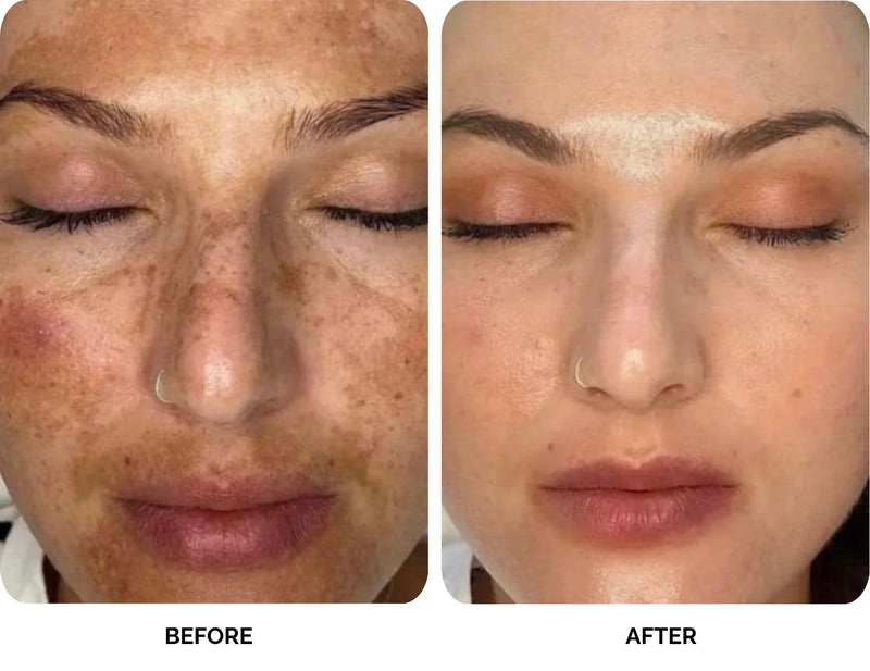 Before and after results of Lavié Labs melasma treatment showing cleared dark patches after 45 days