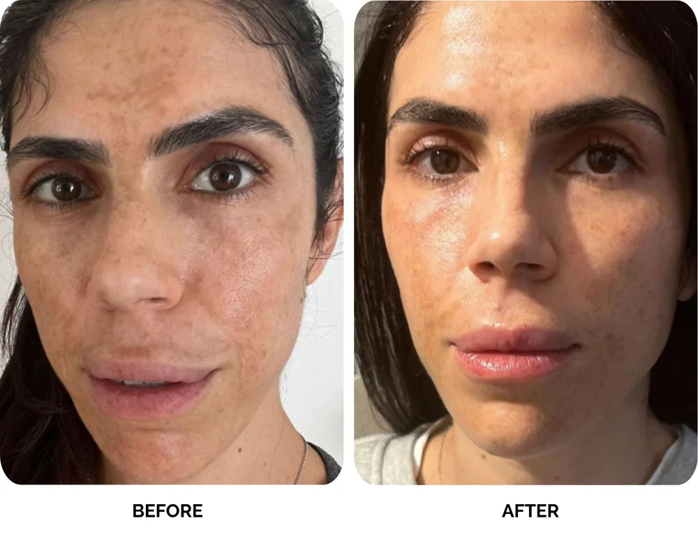 Before and after results of Lavié Labs pigment treatment showing pigmentation and discoloration cleared after 5 months