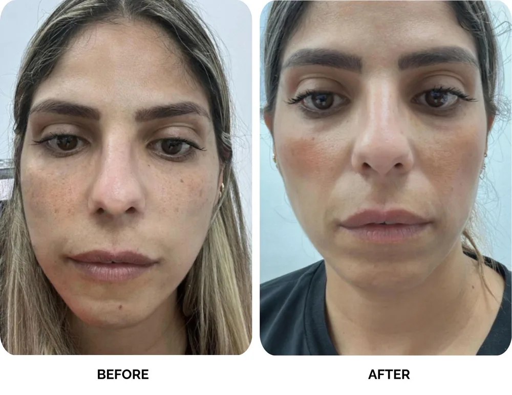 Before and after results of Lavié Labs pigment treatment showing pigmentation and sun damage cleared after 3 months