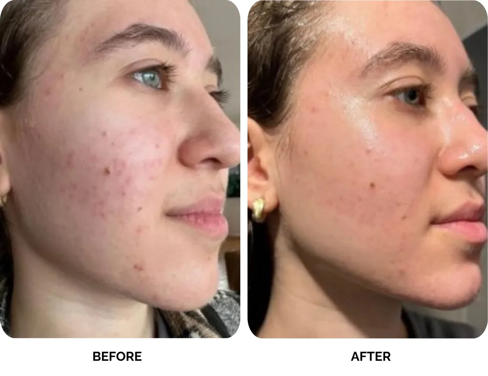 Before and after results of Lavié Labs clarifying treatment showing acne and pimples reduced after 2 weeks