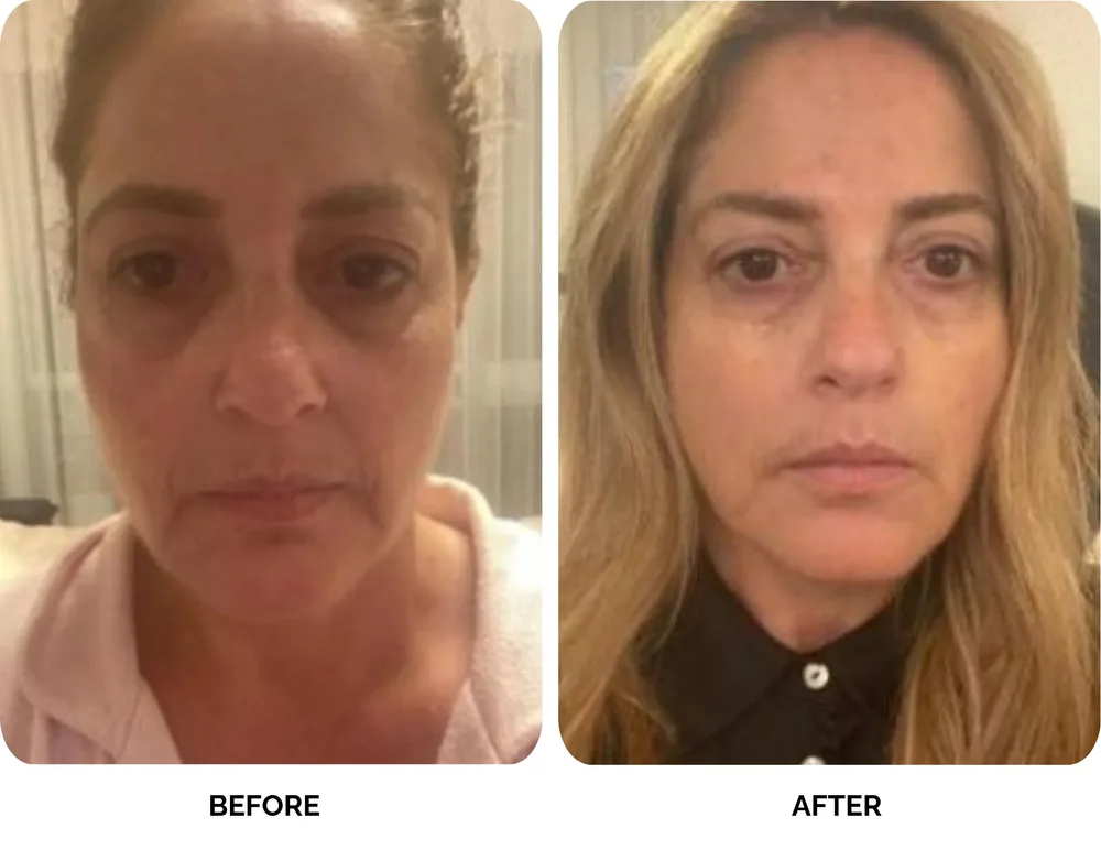 Before and after results of Lavié Labs renewal treatment showing fine lines and wrinkles minimised after 3 months