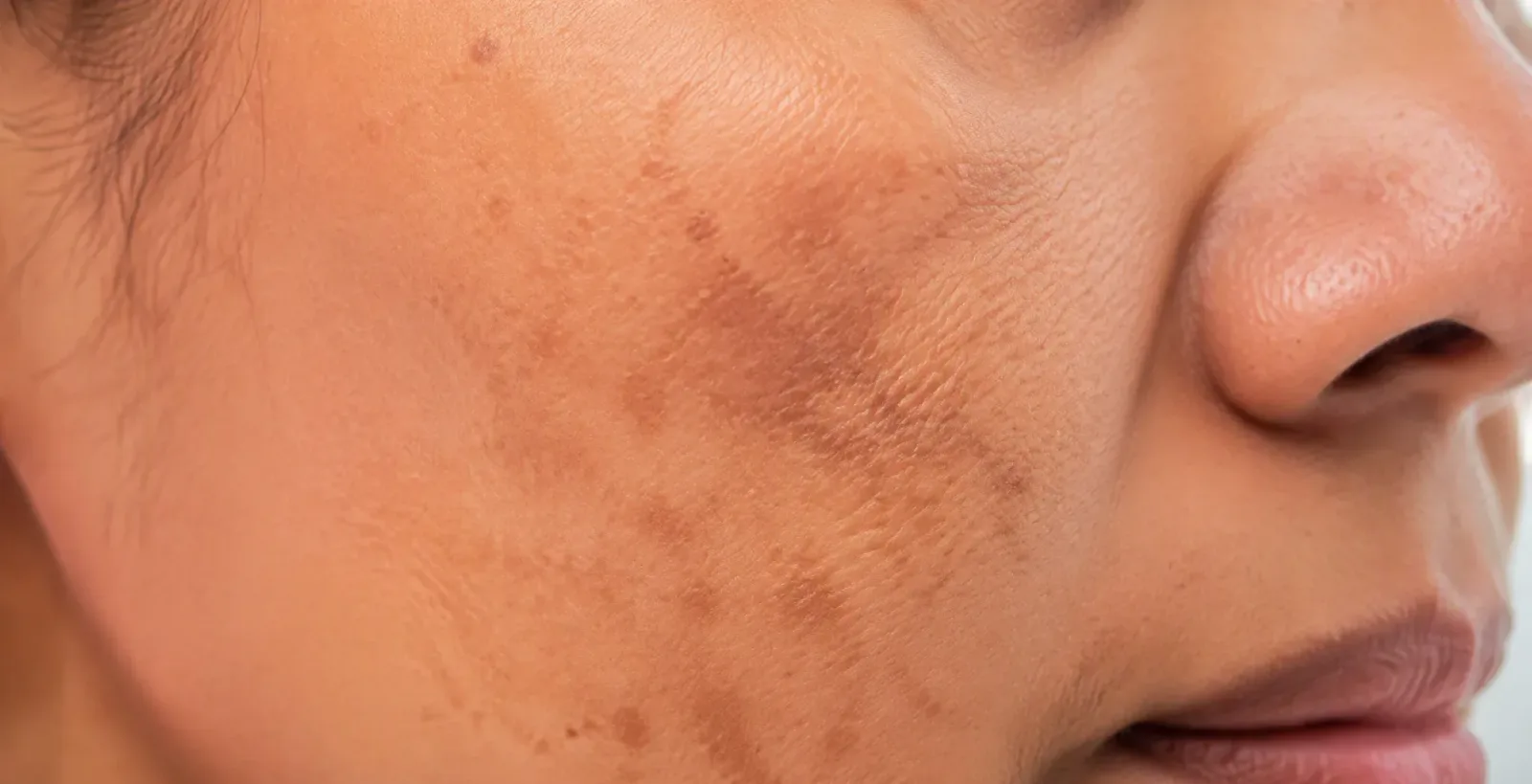 Hyperpigmentation skin texture detail